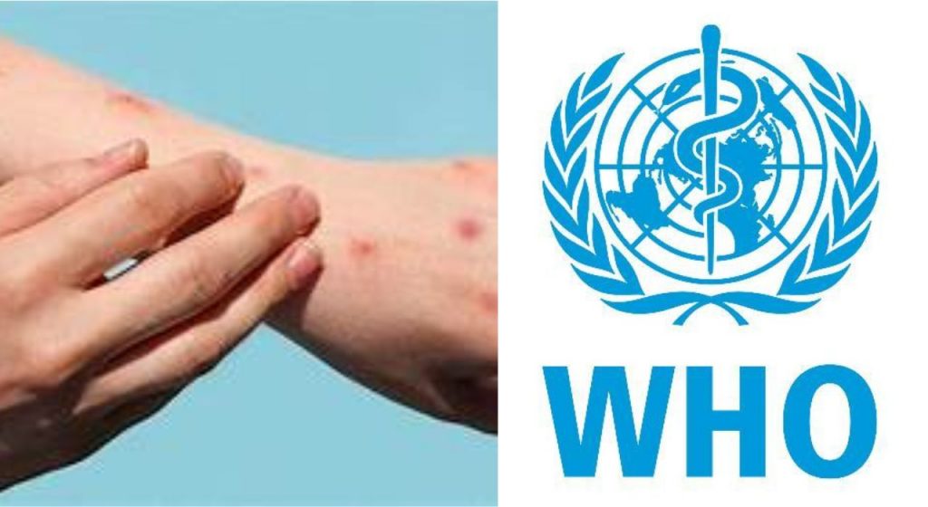 Japan Mpox : टेन्शन वाढलं! जपानमध्ये 'या' घातक आजाराचा पहिला बळी; WHO अलर्ट