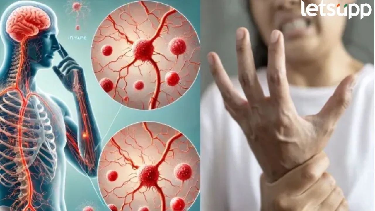 Gullaine Barre Syndrome