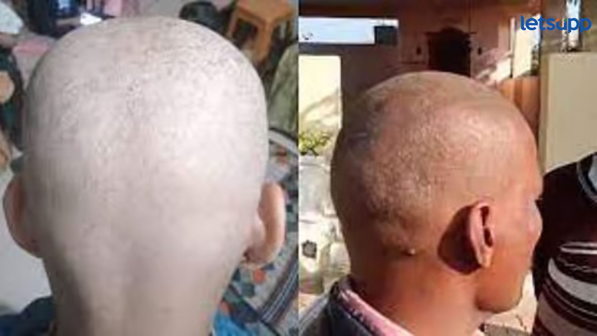 Buldhana Hair Loss