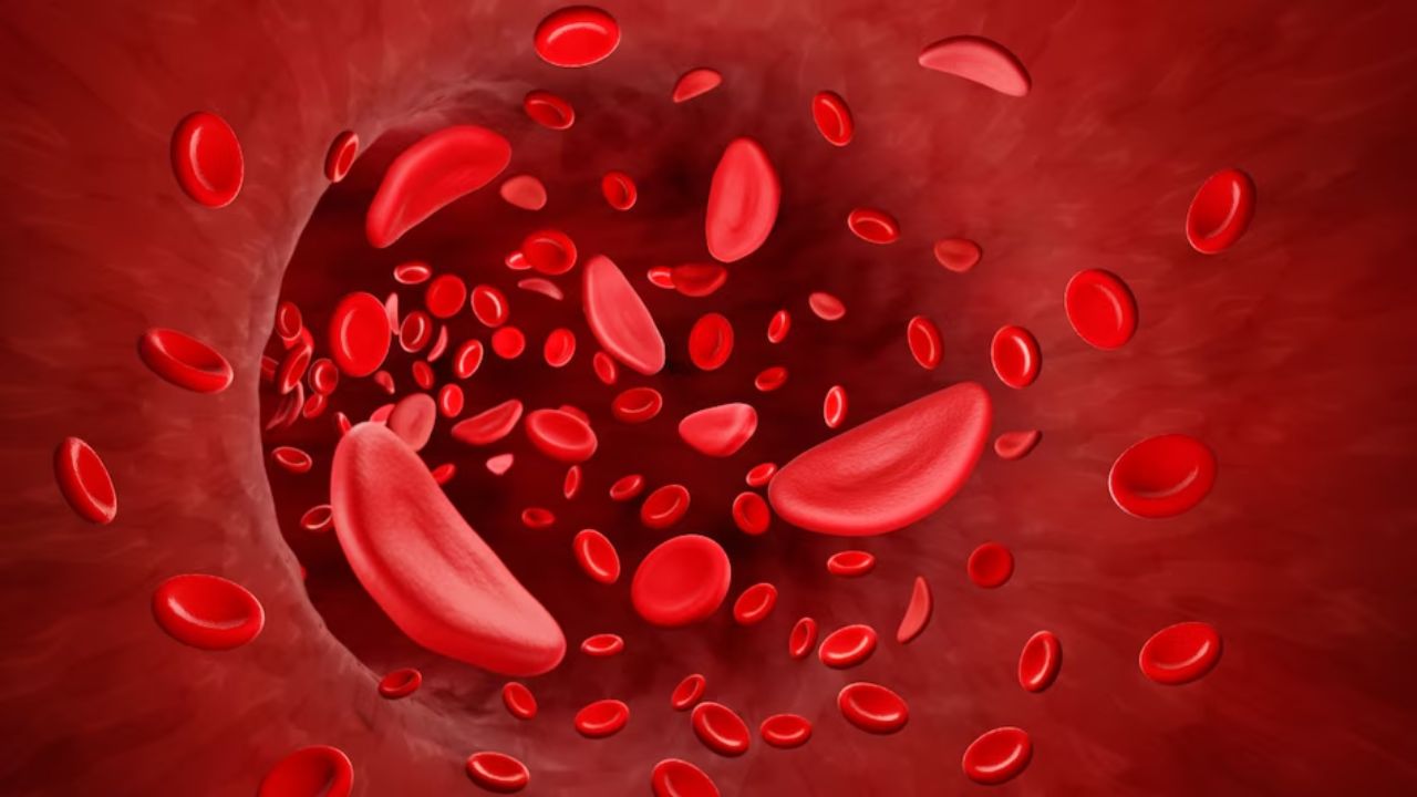Sickle Cell Anemia