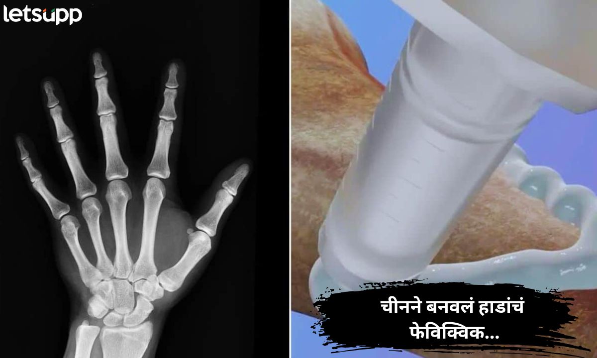 वस्तुंप्रमाणे अवघ्या काही मिनिटांत हाडंही चिटकवता येणार! चीनने बनवलं हाडांचं फेविक्विक… Chinese Scientists