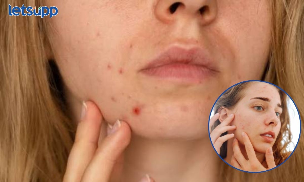 Pimples Before Period
